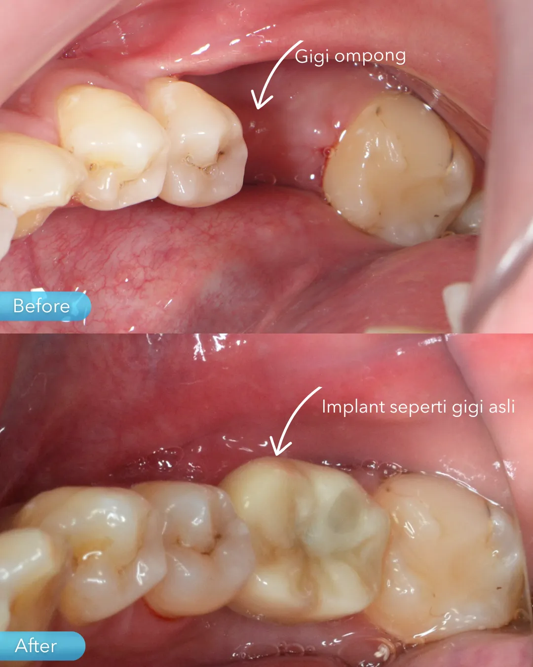 Dental implant result